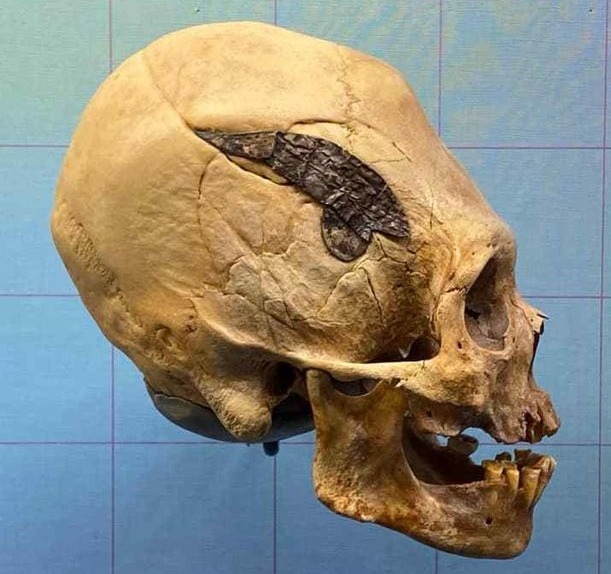 Crânio Alongado Peruano, Implante de Metal em Cirurgia Antiga, Práticas Cirúrgicas em Civilizações Pré-Incaicas, Trepanação e Saúde Neurológica, Artefatos Arqueológicos Misteriosos, Modificações Cranianas na Antiguidade, Medicina Pré-Incaica, Técnicas Cirúrgicas em Guerras Antigas, Fusão Óssea em Cirurgia Milenar, Trepanação e Práticas Médicas, Autenticidade de Artefatos Arqueológicos, Crânio Alongado e Cultura Étnica, Mistérios da Medicina Sul-Americana, Evolução das Práticas Cirúrgicas, História da Trepanação, Civilizações Sul-Americanas Antigas, Impacto Cultural das Modificações Corporais, Osteologia e Estudos Cranianos, Artefatos Arqueológicos Enigmáticos no Peru, Pesquisas em Museus de Osteologia.