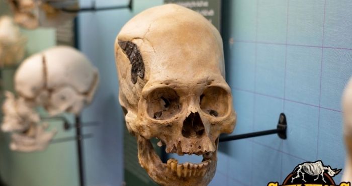 Crânio Alongado Peruano, Implante de Metal em Cirurgia Antiga, Práticas Cirúrgicas em Civilizações Pré-Incaicas, Trepanação e Saúde Neurológica, Artefatos Arqueológicos Misteriosos, Modificações Cranianas na Antiguidade, Medicina Pré-Incaica, Técnicas Cirúrgicas em Guerras Antigas, Fusão Óssea em Cirurgia Milenar, Trepanação e Práticas Médicas, Autenticidade de Artefatos Arqueológicos, Crânio Alongado e Cultura Étnica, Mistérios da Medicina Sul-Americana, Evolução das Práticas Cirúrgicas, História da Trepanação, Civilizações Sul-Americanas Antigas, Impacto Cultural das Modificações Corporais, Osteologia e Estudos Cranianos, Artefatos Arqueológicos Enigmáticos no Peru, Pesquisas em Museus de Osteologia.