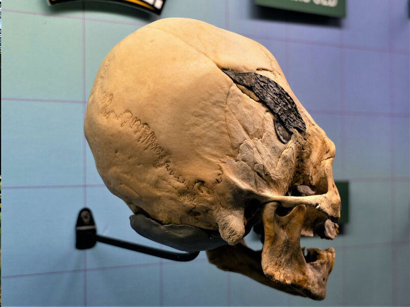 Crânio Alongado Peruano, Implante de Metal em Cirurgia Antiga, Práticas Cirúrgicas em Civilizações Pré-Incaicas, Trepanação e Saúde Neurológica, Artefatos Arqueológicos Misteriosos, Modificações Cranianas na Antiguidade, Medicina Pré-Incaica, Técnicas Cirúrgicas em Guerras Antigas, Fusão Óssea em Cirurgia Milenar, Trepanação e Práticas Médicas, Autenticidade de Artefatos Arqueológicos, Crânio Alongado e Cultura Étnica, Mistérios da Medicina Sul-Americana, Evolução das Práticas Cirúrgicas, História da Trepanação, Civilizações Sul-Americanas Antigas, Impacto Cultural das Modificações Corporais, Osteologia e Estudos Cranianos, Artefatos Arqueológicos Enigmáticos no Peru, Pesquisas em Museus de Osteologia.